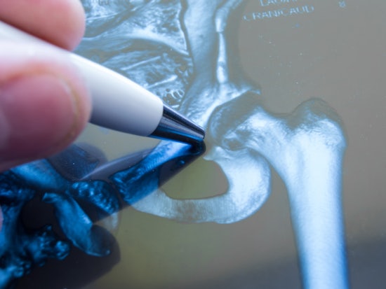 <p>Research shows 25 percent of elderly hip fracture patients will have died in the year after discharge (Source: Shutterstock)</p>
