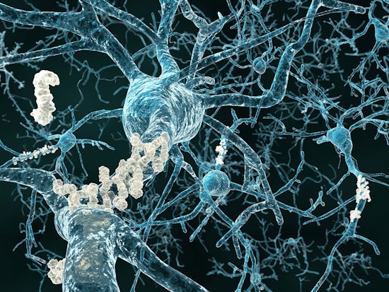 <p>The way amyloid proteins bunch together in the brain could indicate the subtype of Alzheimer’s a person is living with (Source: Shutterstock)</p>
