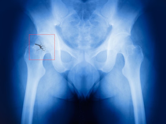 <p>New research is calling for hospitals to make osteoporosis plans a priority for patients leaving hospital after hip fracture (Source: Shutterstock)</p>
