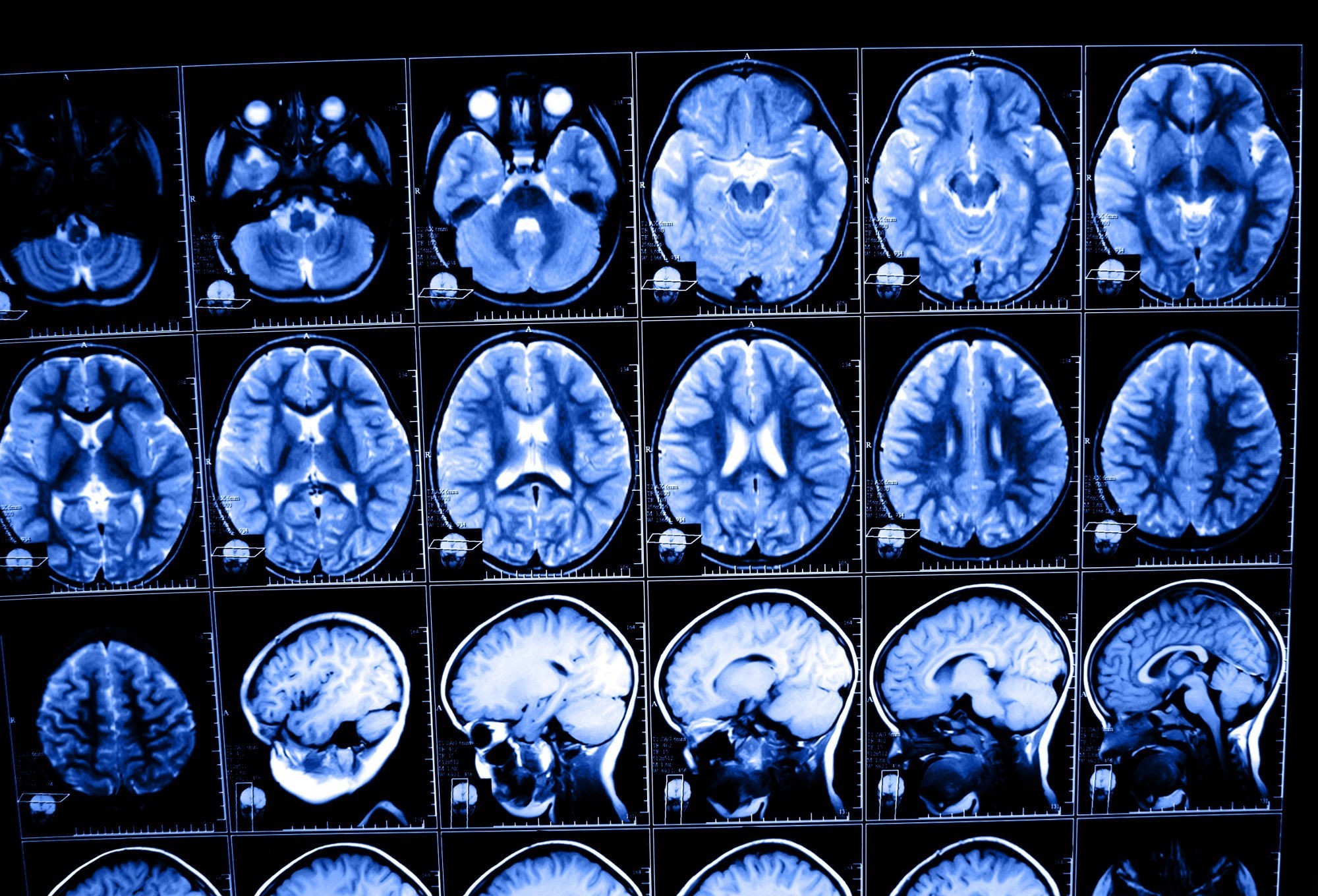 <p>Scientists at the University of Queensland (UQ) have discovered that magnetic resonance imaging (MRI) could be used to predict the risk of Alzheimer’s disease.</p>
