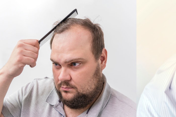 As we age, some men begin to experience male pattern baldness, but for older men who wish to regain some of their lost confidence or personal aesthetic, options are available. (Source: Shutterstock)
