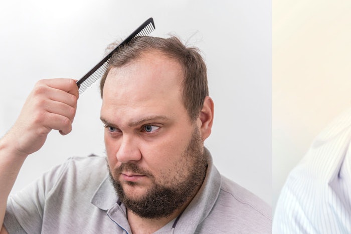 As we age, some men begin to experience male pattern baldness, but for older men who wish to regain some of their lost confidence or personal aesthetic, options are available. (Source: Shutterstock)