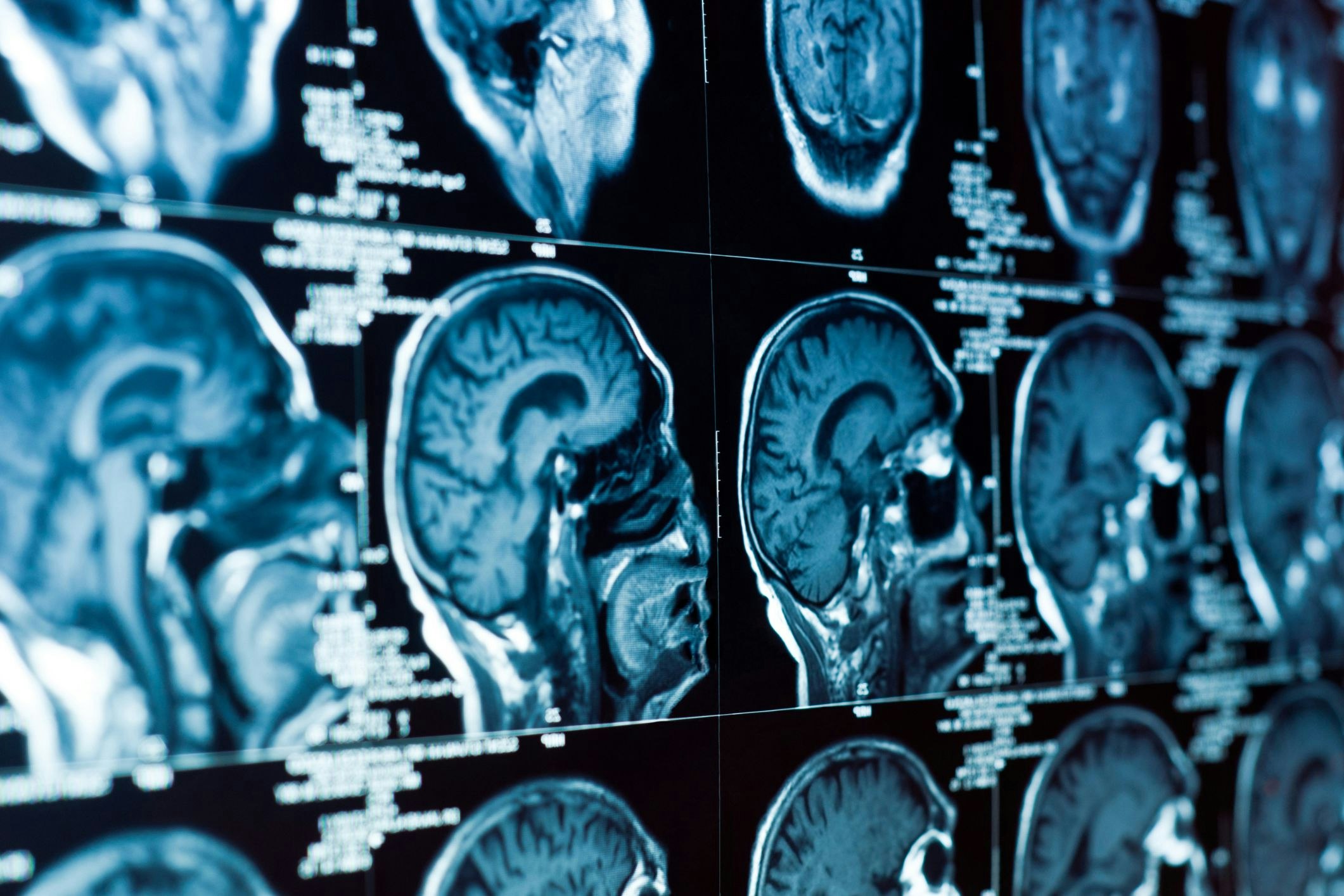 <p>The approach developed by the Monash University team opened new opportunities for mapping brain changes in mental illness. [Source: Shutterstock]</p>
