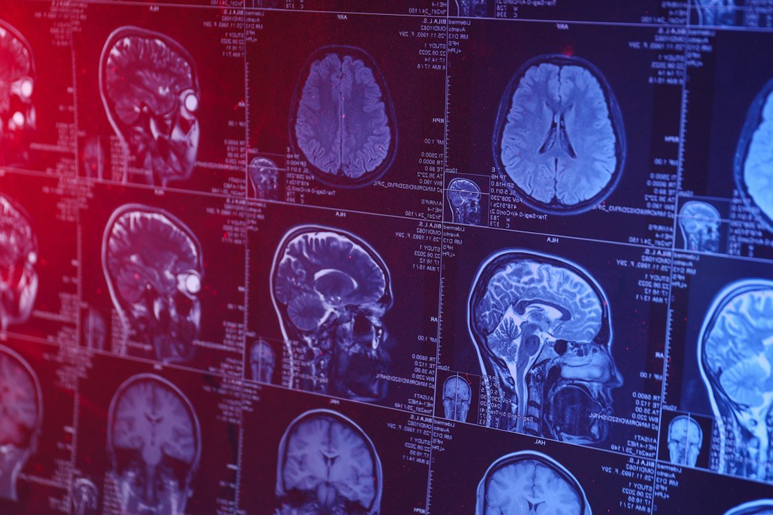 Dementia is not inevitable: Why it’s time to act on brain health | Aged ...