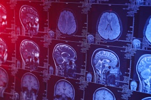 Dementia is not inevitable: Why it’s time to act on brain health