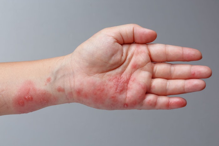 Once a person gets the chickenpox virus, the condition may lay dormant and flare-up later in life in the form of shingles. (Source: Shutterstock)
