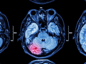 Acquired brain injury: What are the different types and how are they caused?